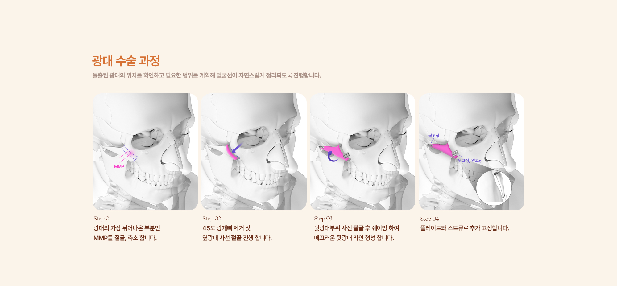 광대수술