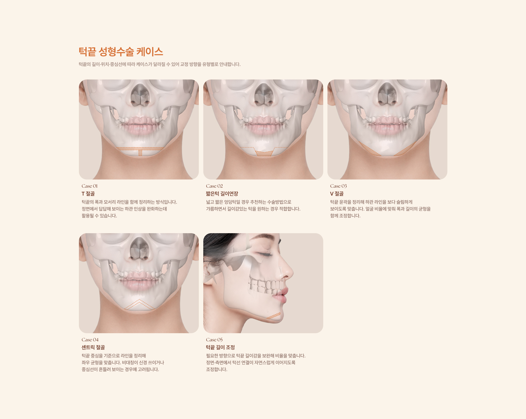 턱끝성형수술