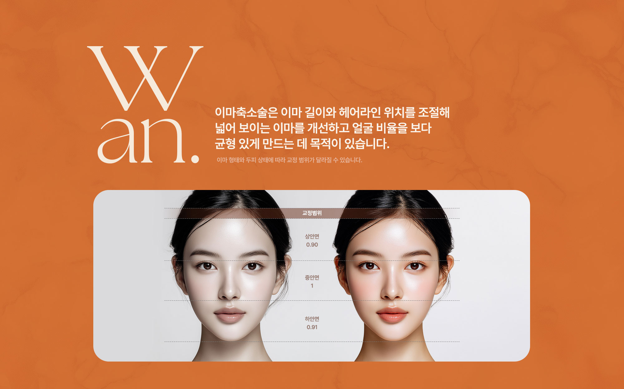 이마축소술