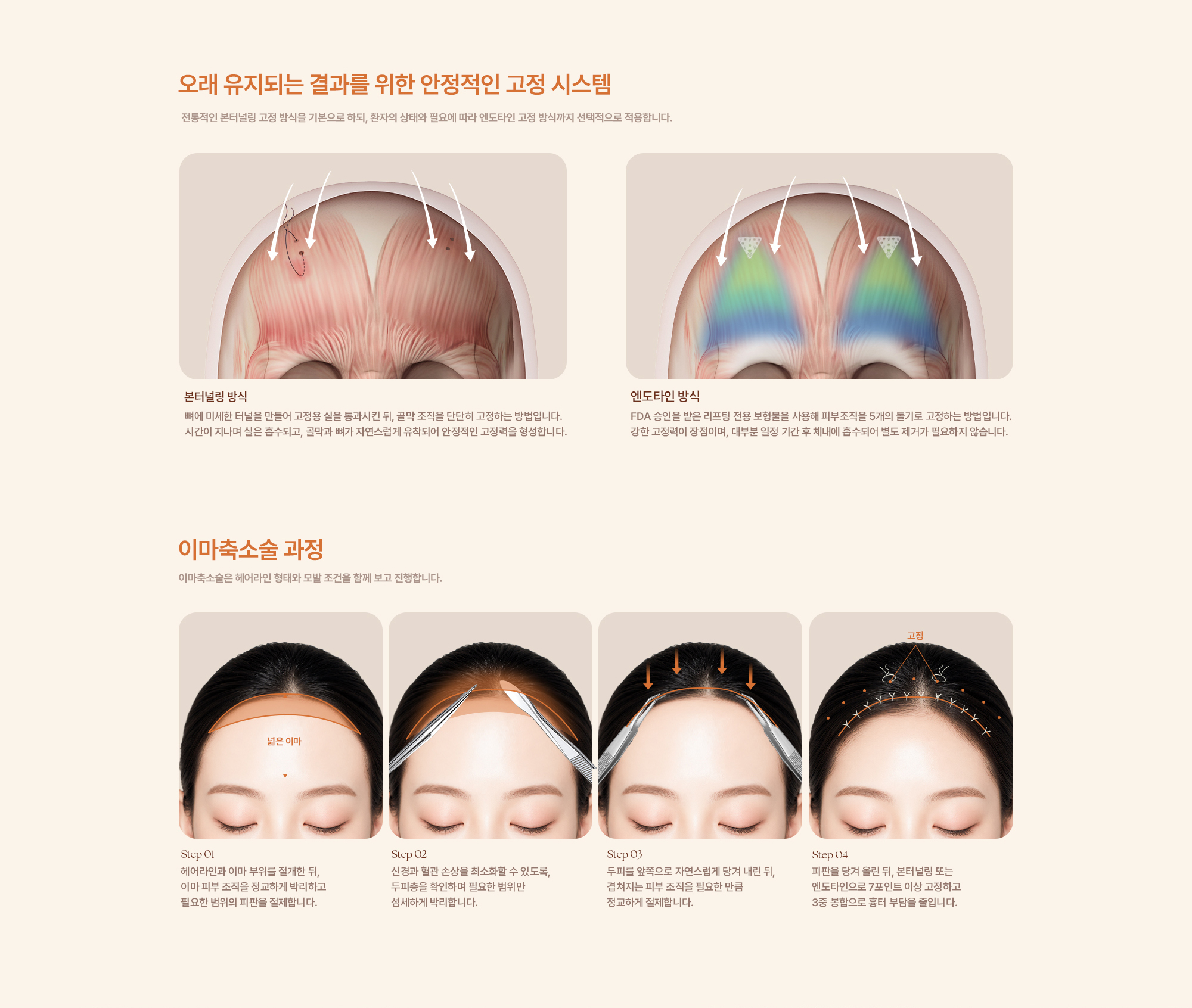 이마축소술
