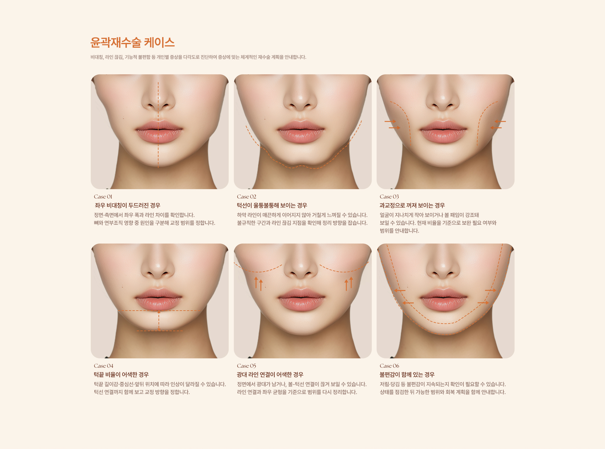 윤곽재수술