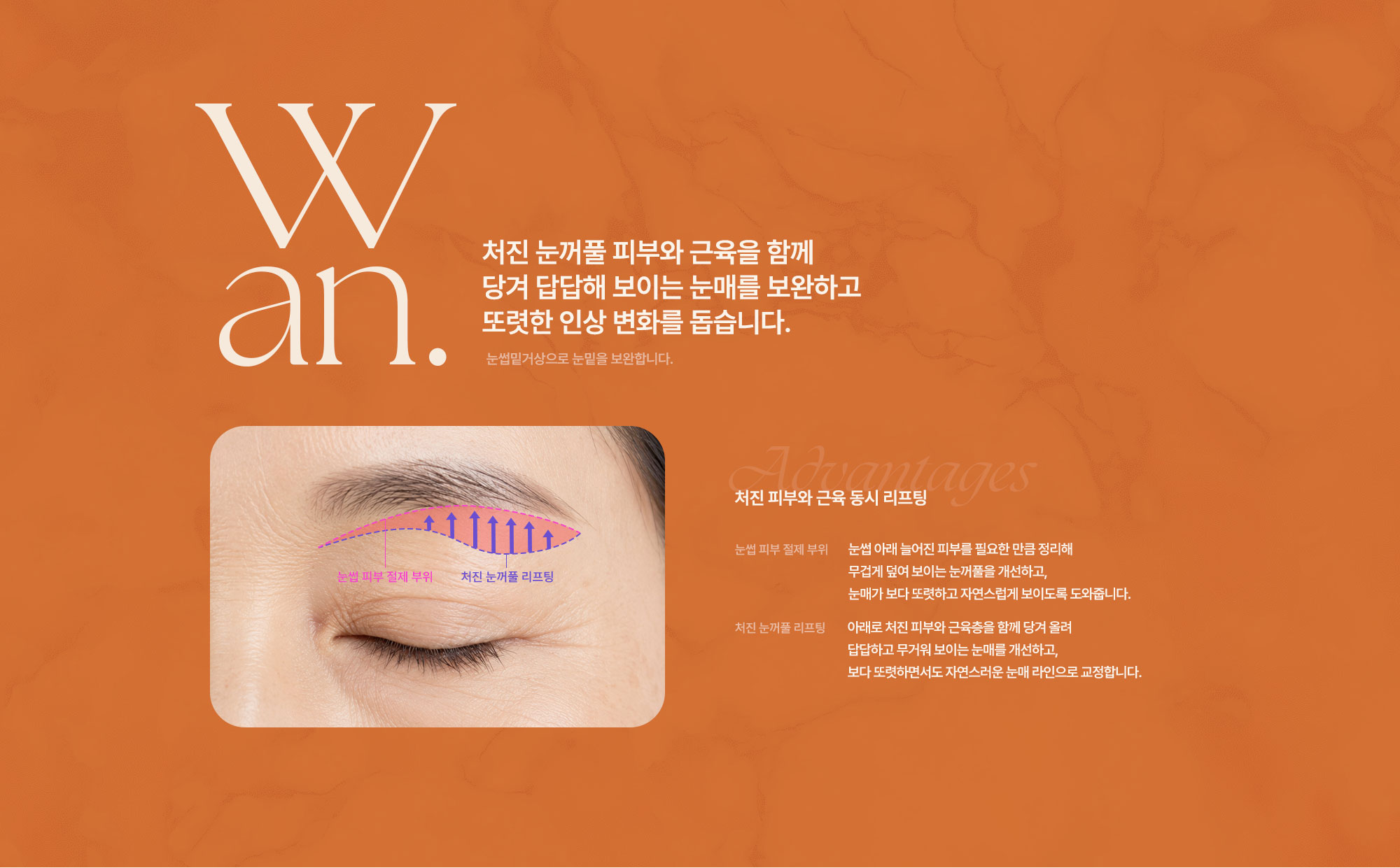 눈썹밑거상