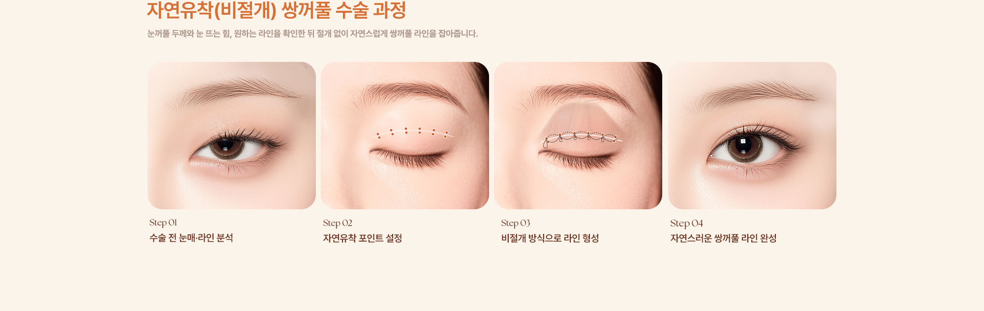 쌍꺼풀 수술