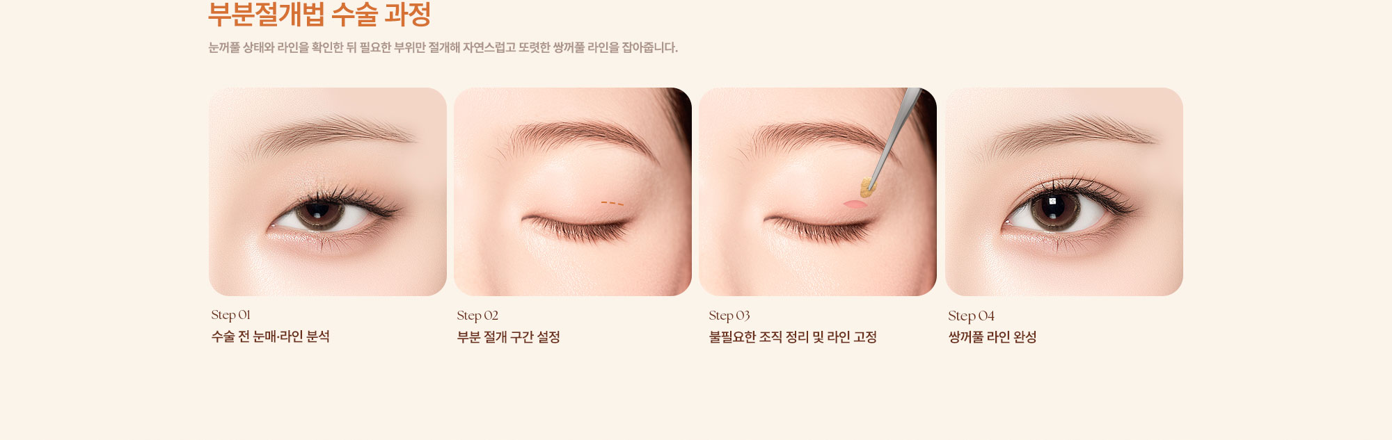 쌍꺼풀 수술