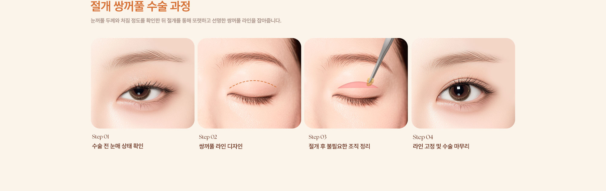 쌍꺼풀 수술