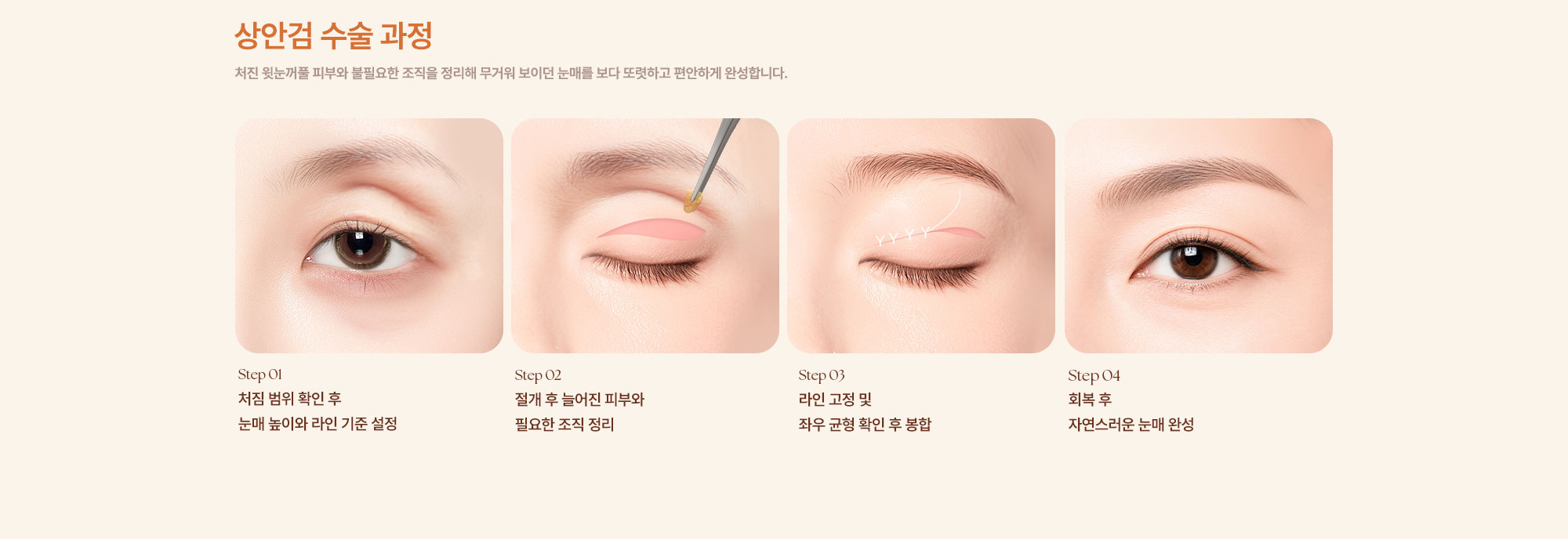 중년 눈수술