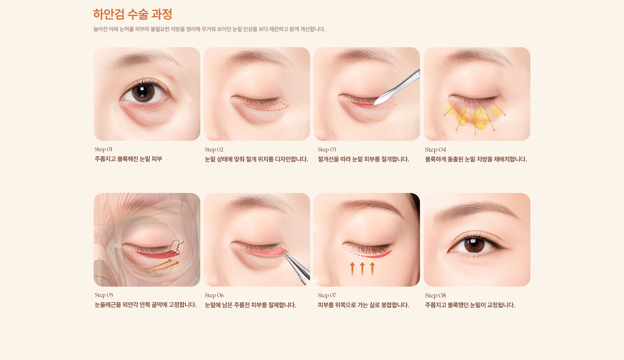 중년 눈수술