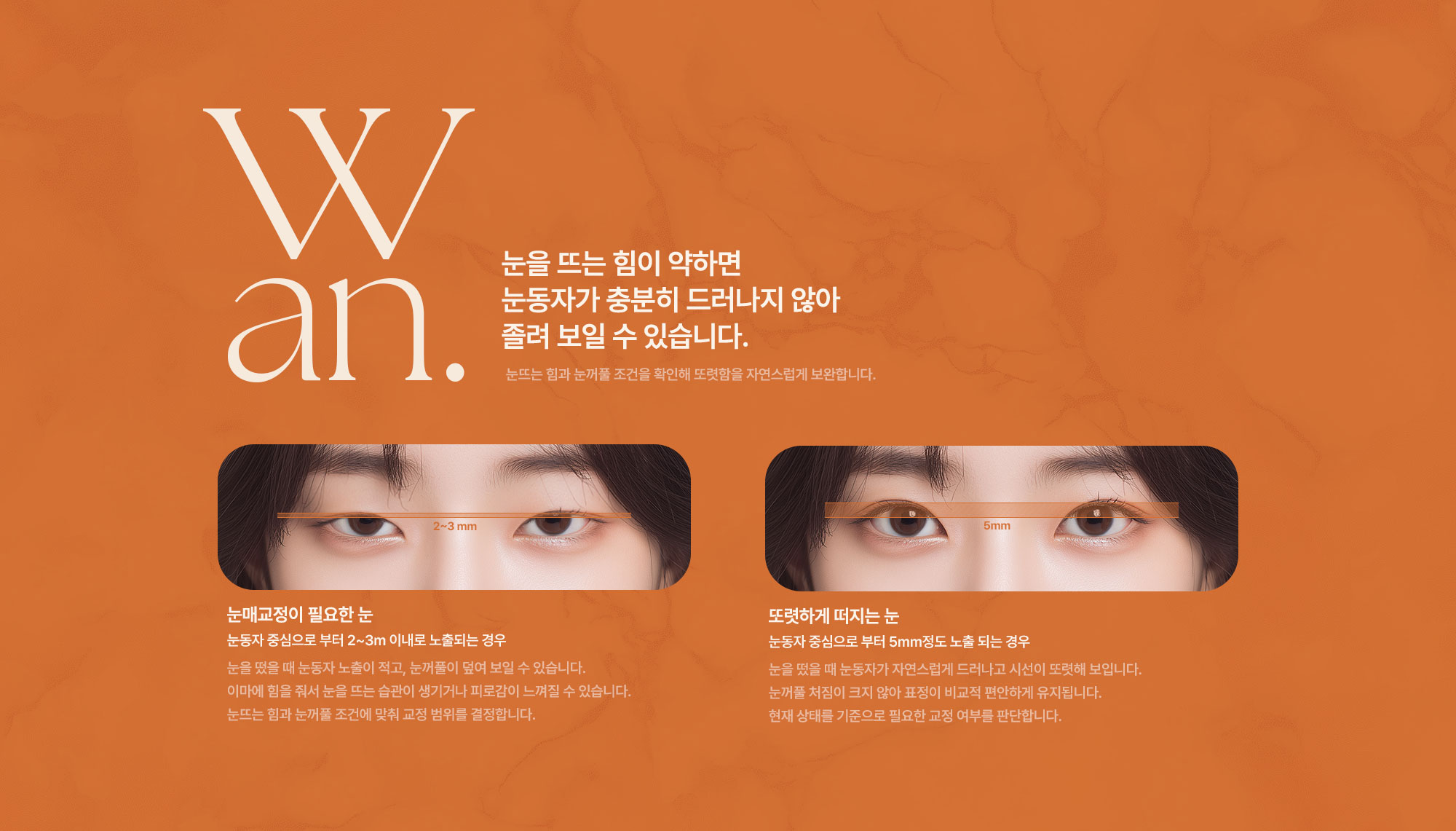 눈매교정수술