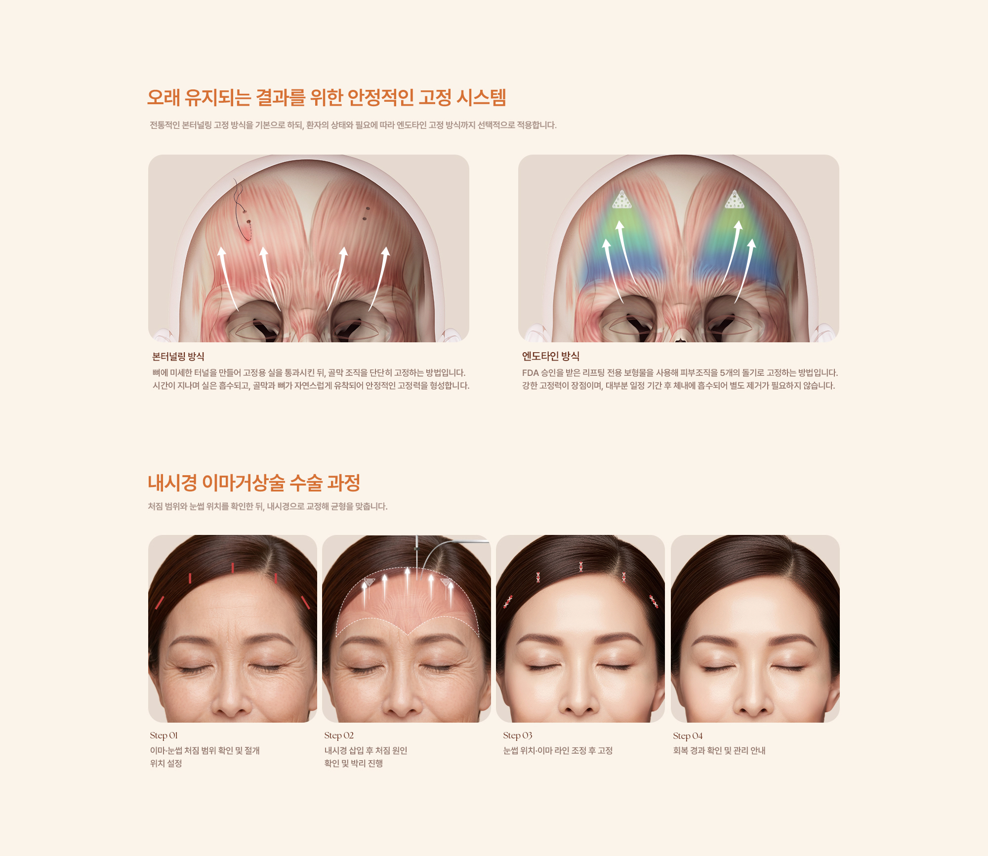 내시경 이마거상술