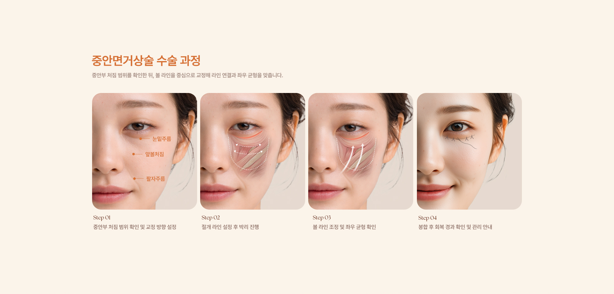 중안면거상술
