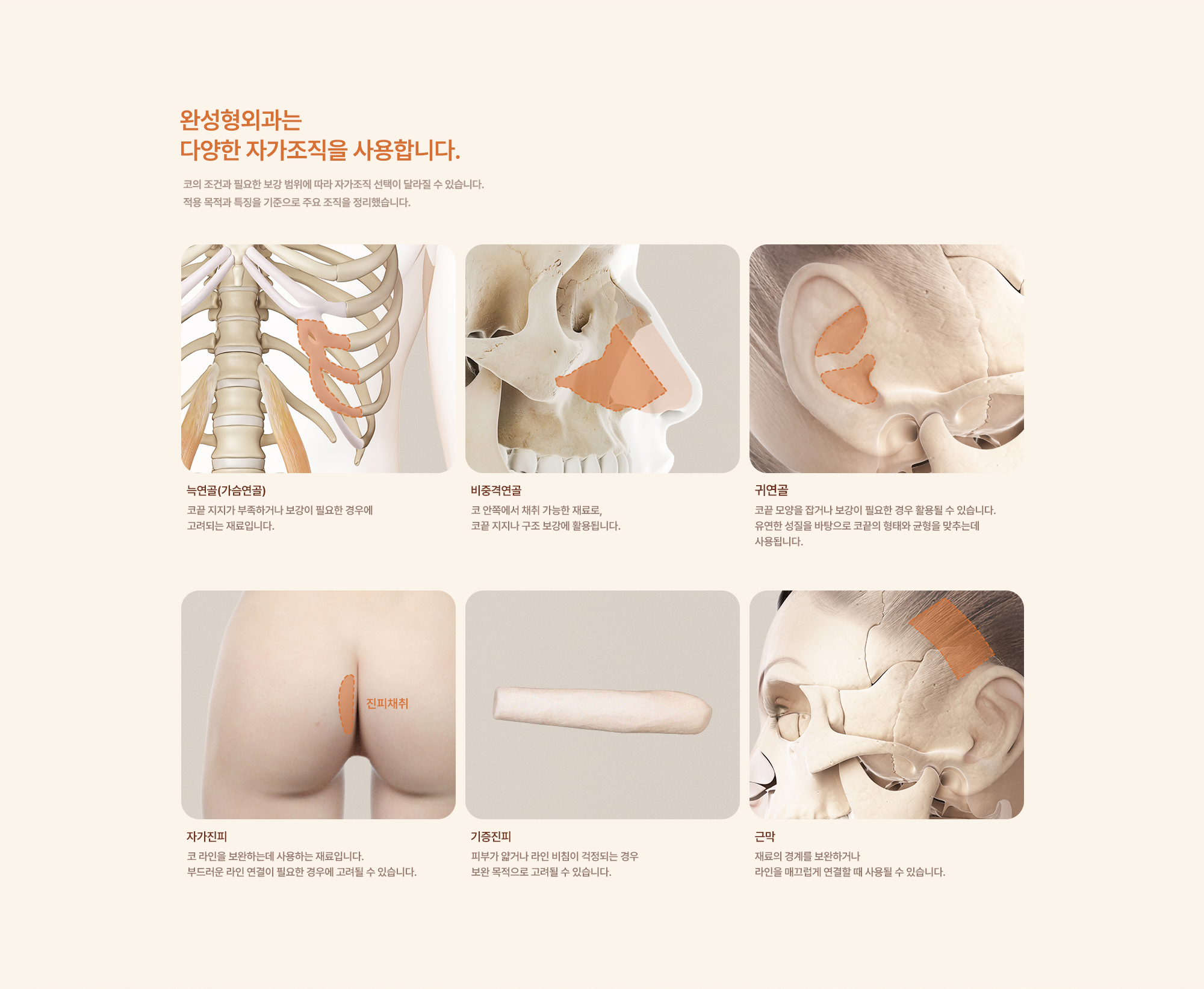 무보형물 코성형