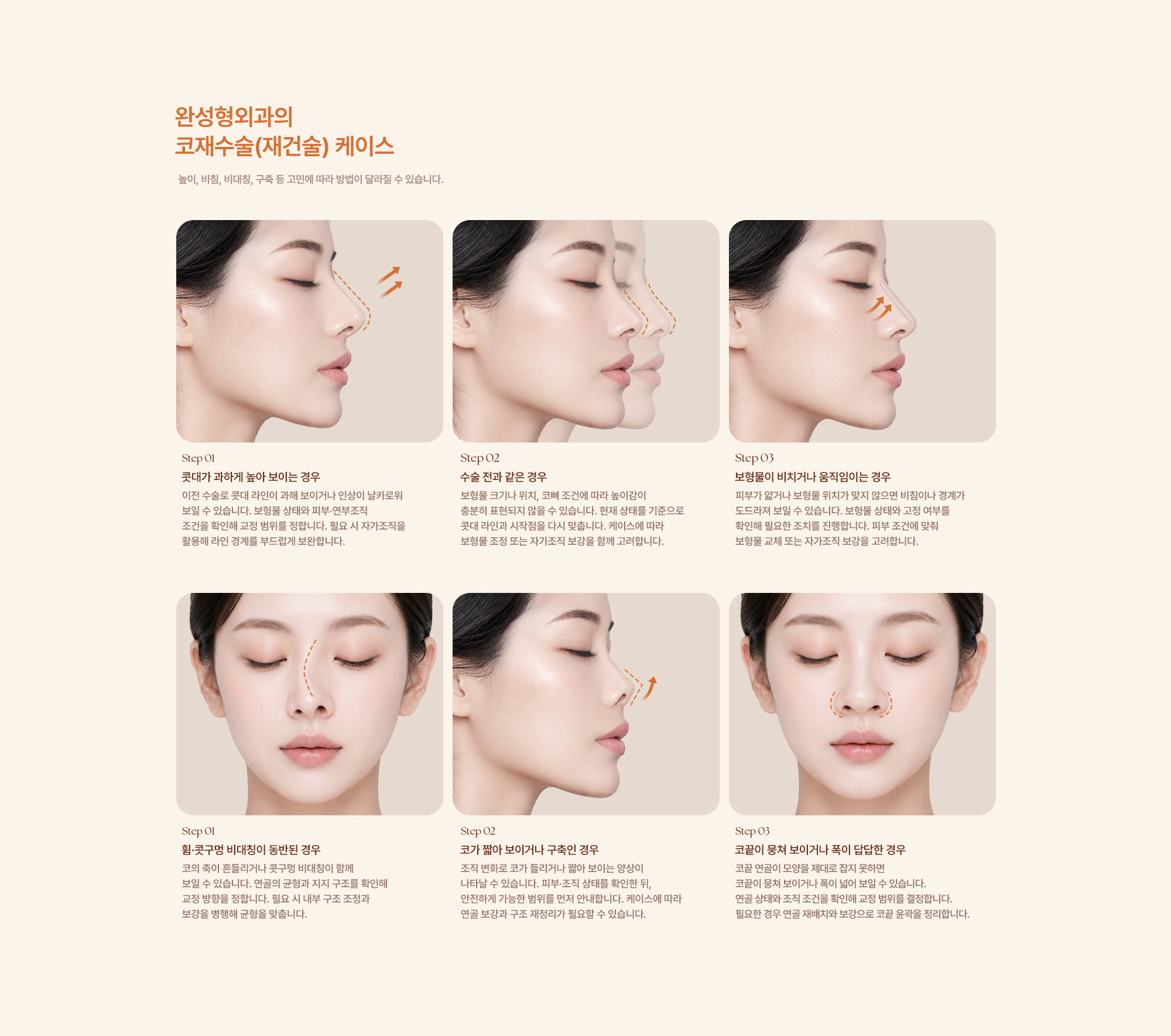 코재수술(재건술)