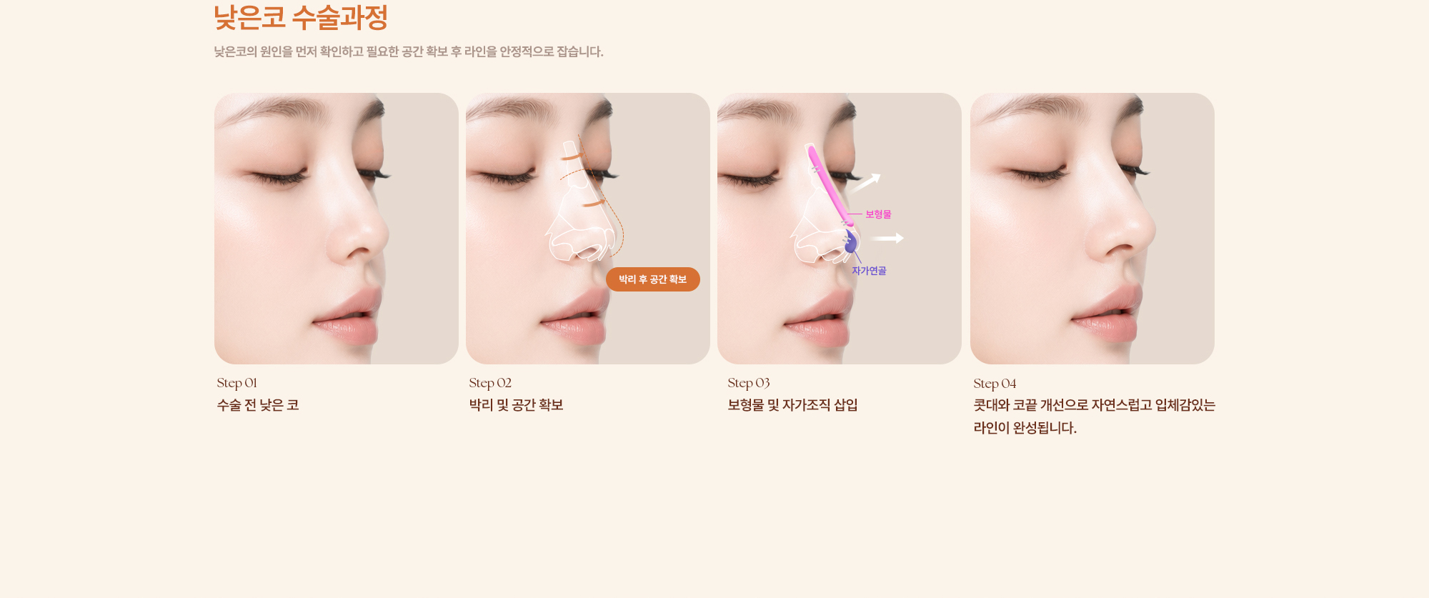 완성형외과 코수술