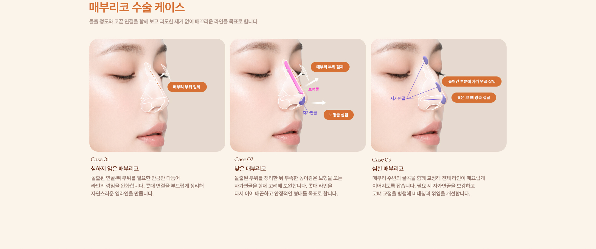 완성형외과 코수술