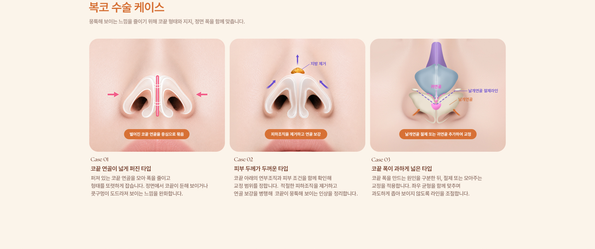 완성형외과 코수술