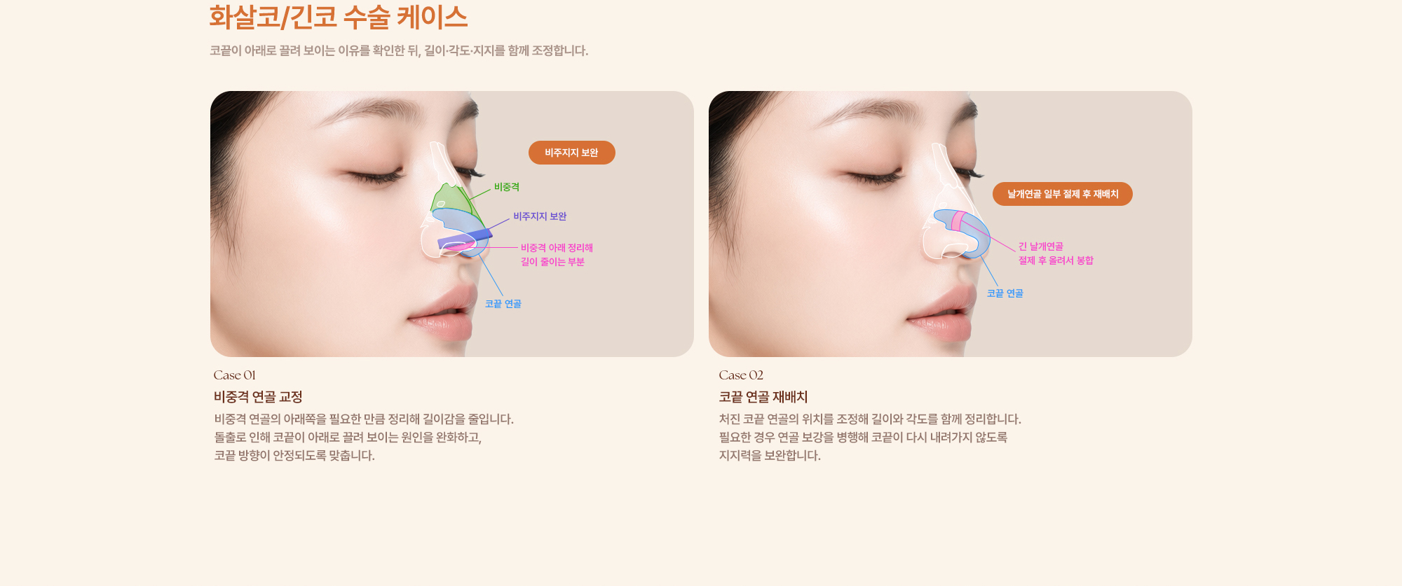 완성형외과 코수술