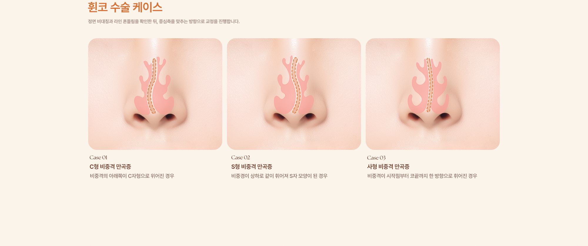 완성형외과 코수술